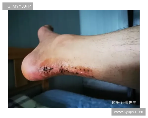 跟腱断裂后的全面康复训练与功能恢复策略解析 跟腱断裂后的全面康复训练与功能恢复策略解析